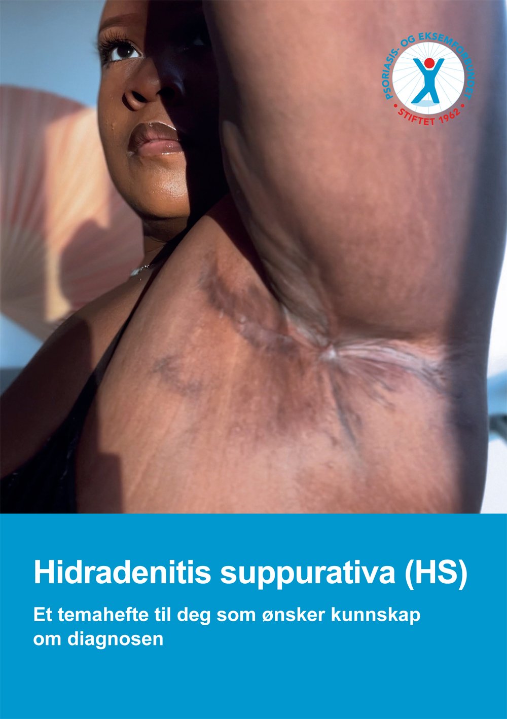 Hidradenitis suppurativa (HS)