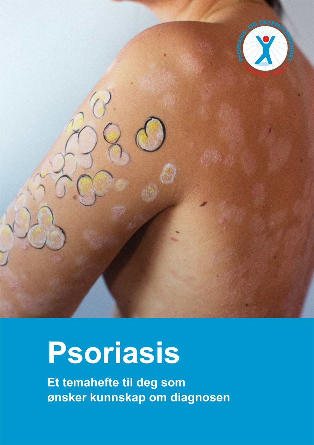 Psoriasis