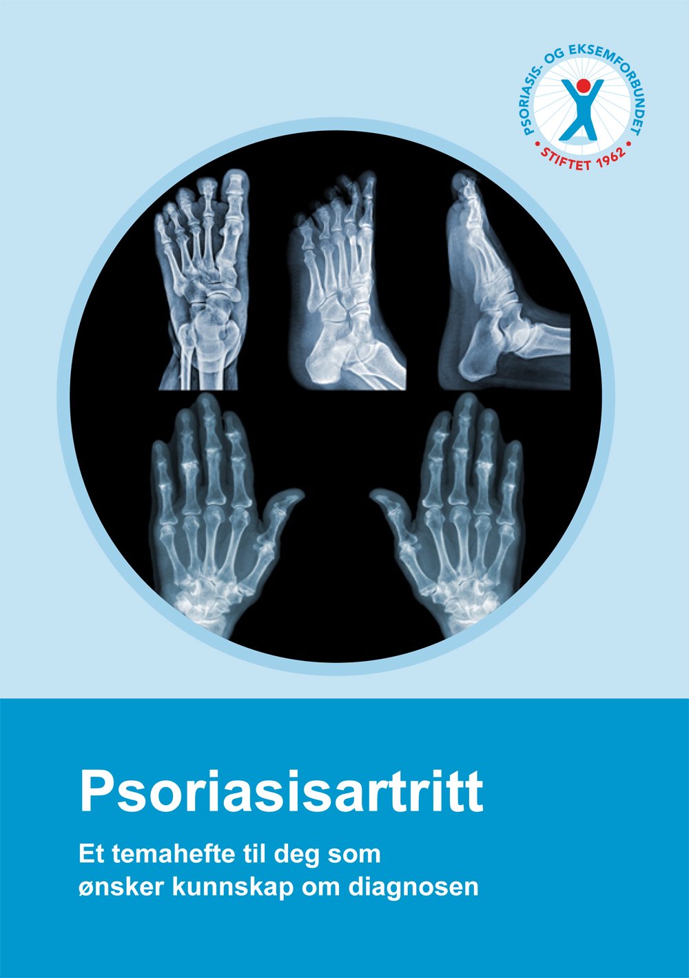 Psoriasisartritt